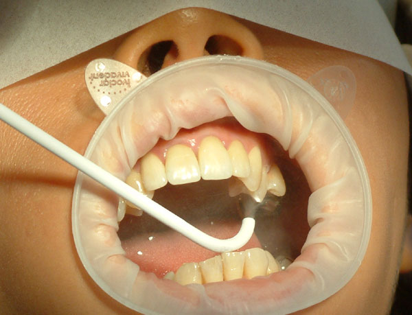 Jak zapobiegać chorobom zębów