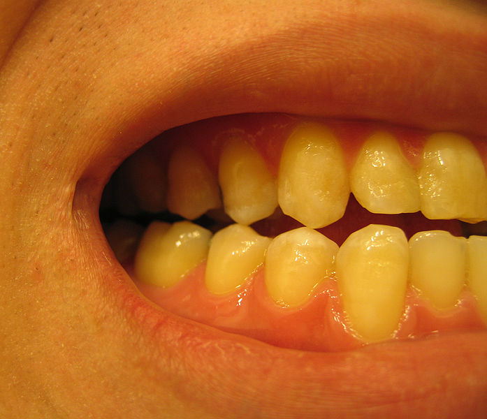 Nadwrażliwość zębiny